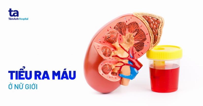 Hinh anh minh hoa cac buoc xet nghiem va chan doan khi bi tieu ra mau o nu gioi